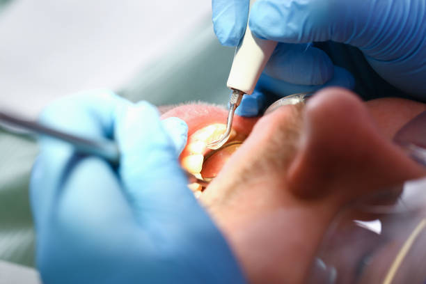 Best Emergency Gum Treatment in Fayette, LA