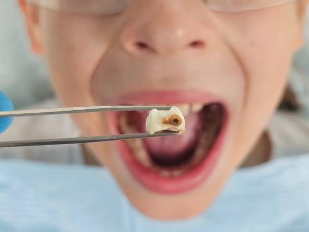 Best Emergency Wisdom Teeth Removal in Fayette, LA